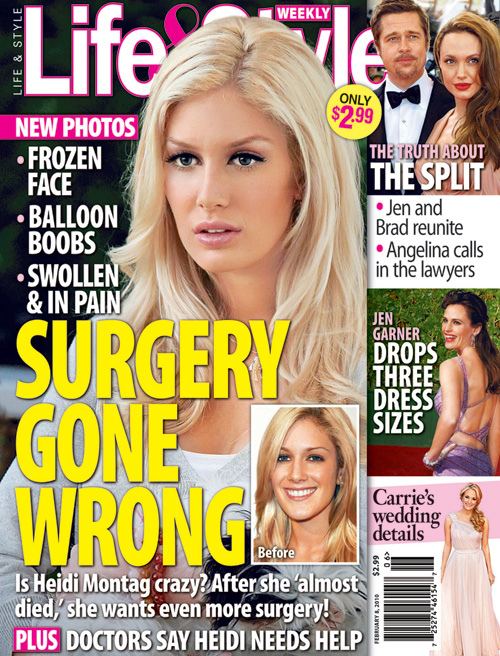 heidi montag after surgery. After Heidi Montag went under