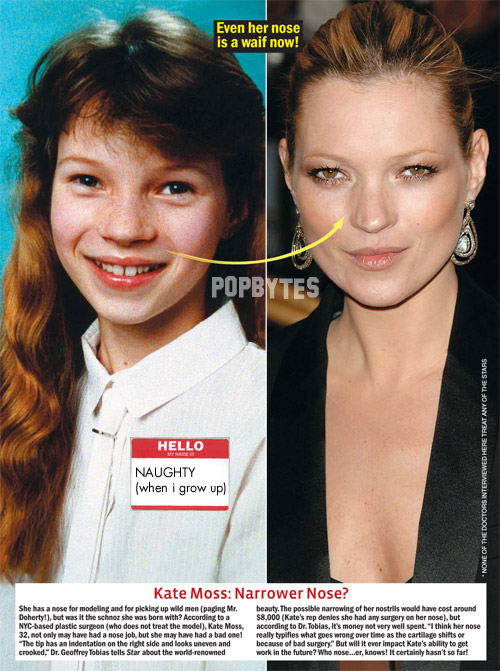 before and after nose jobs celebrity. in rhinoplasty! one doctor